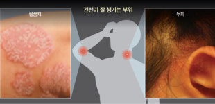 가을만 되면 온몸이 근질근질...습진 같은 너, 그이름은 건선