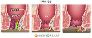 대항병원, 수술 13만건에 재발률 1% 미만...항문질환 뿌리까지 뽑는다