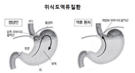 위식도역류 수술환자 진작 수술할 걸