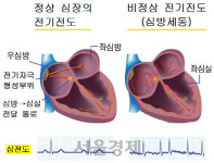 심방세동 유발 심장 부위 얼려서 치료한다