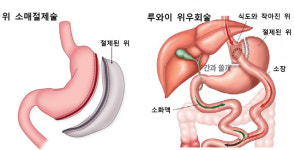 약물치료 안듣는 당뇨환자 위 수술로 고친다