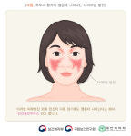루프스병 증상은? 붓고 발진 구강궤양, 신장 망가져 일상 생활X “친구에게 이식 받은 스타”