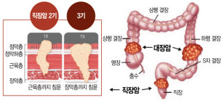 70대 3기 직장암 환자도 적극적 치료 받으세요