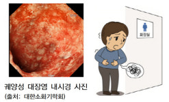 건선 있으면 염증성 장질환 위험 2배