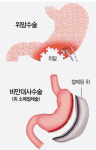암·비만으로 위절제수술 받았다면...비타민B12 보충하세요