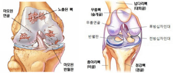 운동후 무릎통증 3~4주 이상 지속땐 연골·인대손상 의심을