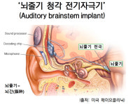 뇌줄기 전기자극기 청신경 손상 따른 난청·이명 동반 개선