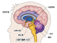 뇌줄기 전기자극기 청신경 손상 따른 난청·이명 동반 개선