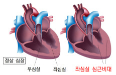 건강검진서 ‘심장비대’ 소견···교정 못하면 심장·간·콩팥·폐 기능 ‘뚝’