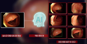 의사들이 놓칠 수 있는 대장용종 16~26% “AI가 잡아낸다”