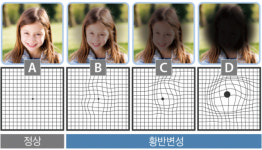 사물이 휘어져 보이는 황반변성, 방치 땐 시력 잃을 수도