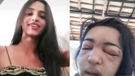 셀프 피어싱 후 얼굴 붓더니 심장마비···10대 소녀의 비극