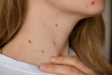 코에 생긴 이 점 미인점인줄 알았는데…휴 잭맨 걸렸던 이 암일 수 있다니 충격