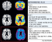 고혈압·당뇨 방치하면 치매 위험
