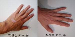 우보한의원, 한약재 ‘백선피’ 백반증에 효과