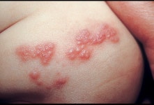 대상포진 예방법..신통이라 불리는 극한의 통증 동반