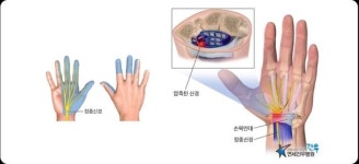 E-스포츠 프로게이머를 은퇴시킨 직업병은?
