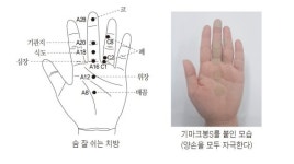 코로나19 일상에 지친 심신건강 돕는 수지침 요법은