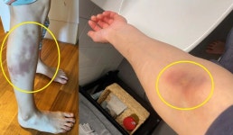 온몸에 저절로 멍이..21년만에 밝혀진 진실에 20대女 며칠동안 울었다 [헬스톡]