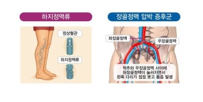 하지정맥류? 장골정맥압박증후군? 헷갈린다면…