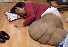 종양이 자라 코끼리 다리가 된 금순할머니의 안타까운 사연!