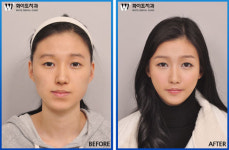 정도 심한 비대칭 얼굴, 양악수술로 균형 맞춘다