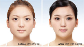 T절골술로 사각턱, 뭉툭한 앞턱을 V라인으로