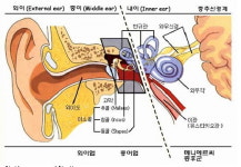 서울대병원 국내 최초 중이이식형보청기 이식수술 성공
