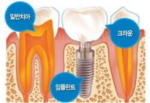 [건강한 인생] 엠앤씨덴탈미래형 인공치아…크라운 지르코스-이 실제 치아 같아 좋네!