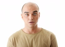 탈모치료, 확실한 효과 원한다면? 모발이식이 답!