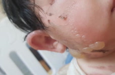 [그 후] 코로나 확진 다음날 아이가 화상을 입었습니다