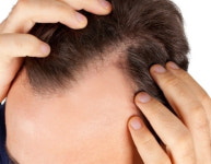 유전자·줄기세포 활용…탈모 치료 새바람