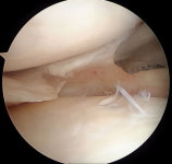 [이수찬의 무릎관절 이야기] 연골을 아끼는 것이 무릎 건강 지름길