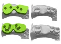 치과보철 시스템을 디지탈화한 케이오디(KOD) 치아 보철법