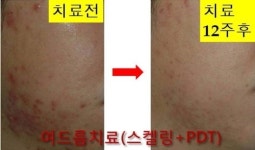 대구 스타S피부과, 여름철 여드름 관리, 화장품에 의존하기보다 정확한 진단과 치료 따라야
