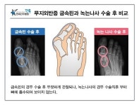 연세건우병원 무지외반증 녹는 나사 삽입술, 2차 수술 부담 없다