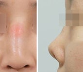 염증으로 변형된 코,  재수술기간 줄인다.