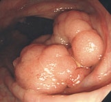 [김태열 기자의 생생건강 365] 대장암, 정기적인 내시경검사로 조기발견하는 것이 중요