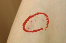 “성묘만 했을 뿐인데” ‘이 상처’ 생각 없이 방치했다 사망까지 이른다?