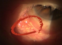 “눈에 ‘돌’ 있다” 실제 사진 충격…너도나도 끼던 렌즈 때문, 이런 일이