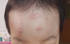 “보고도 못 믿겠다” 이마가 퉁퉁…끔찍한 11월 모기 [지구, 뭐래?]