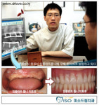 풍치로 잃은 먹는 즐거움! 임플란트로 되찾자
