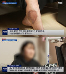 곰 발톱에 다리 피부 뜯긴 사육사…동물원 “대형견에 물렸다”