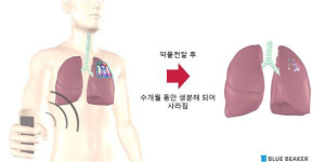 필요한 약물 몸속에 전달하고, 스스로 사라지는 의료기기 개발