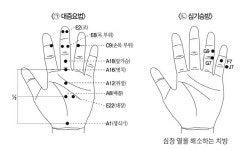폭염의 휴가철, 수지침으로 올 여름을 건강 하게