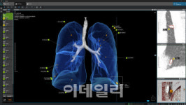 코어라인소프트 ‘AVIEW’ 브라질 시판전 허가 획득