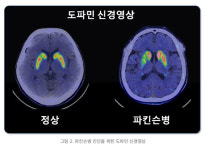 [굿닥터]신경세포 서서히 소실되는 파킨슨병, 도파민제 복용 통해 진행 늦춘다
