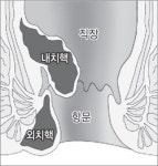 [장이 튼튼해야 생활이 즐겁다]<3>‘부끄러운’ 항문질환