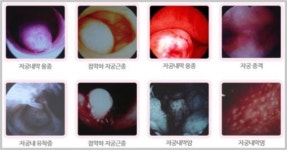 [박세진 원장의 토탈 메디컬 정보] 산부인과 편, ‘자궁내시경’의 모든 것! (자궁 질환 편)