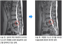 [헬스&뷰티/Before&After]굿스파인병원 허리디스크 수술